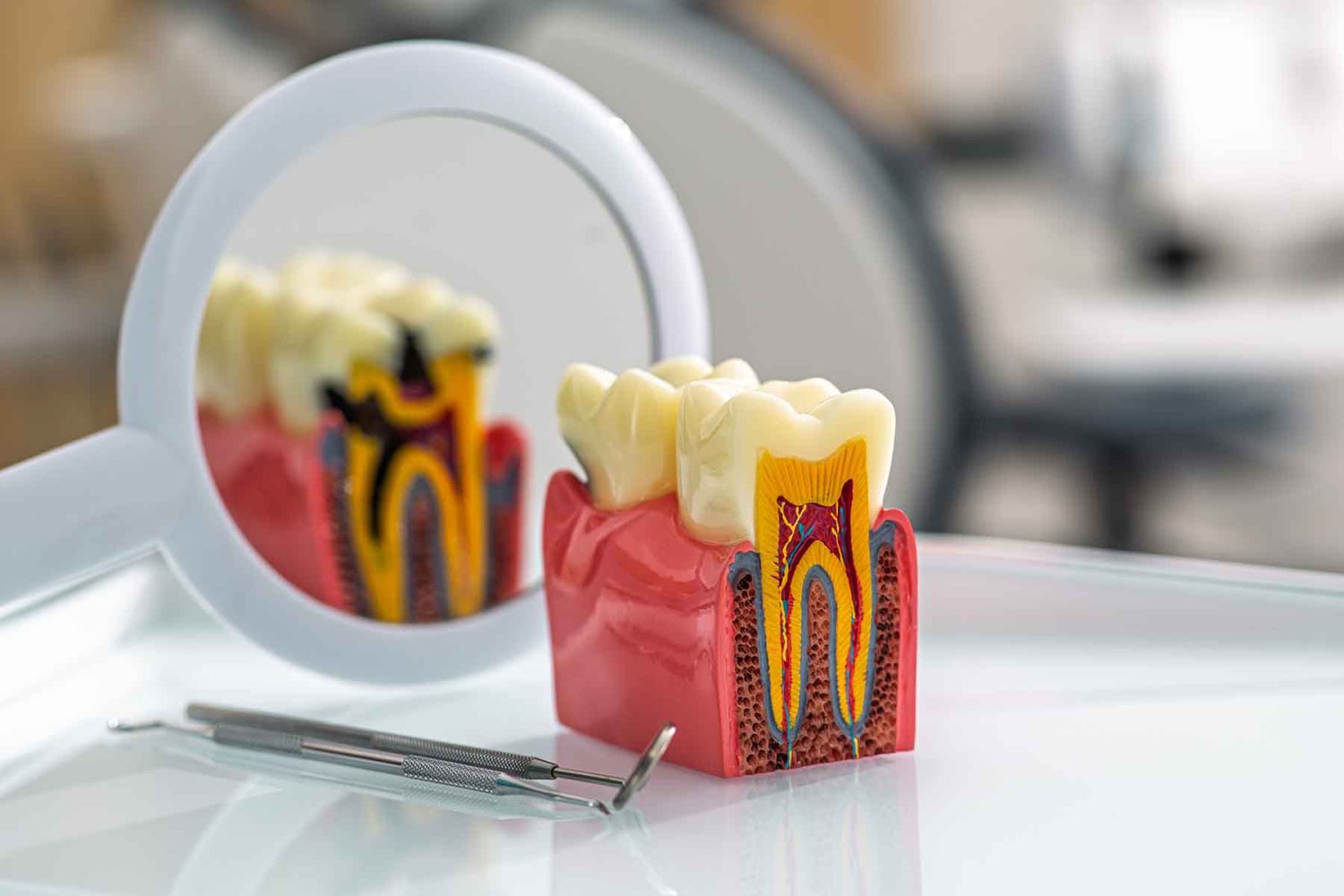 qué son las caries