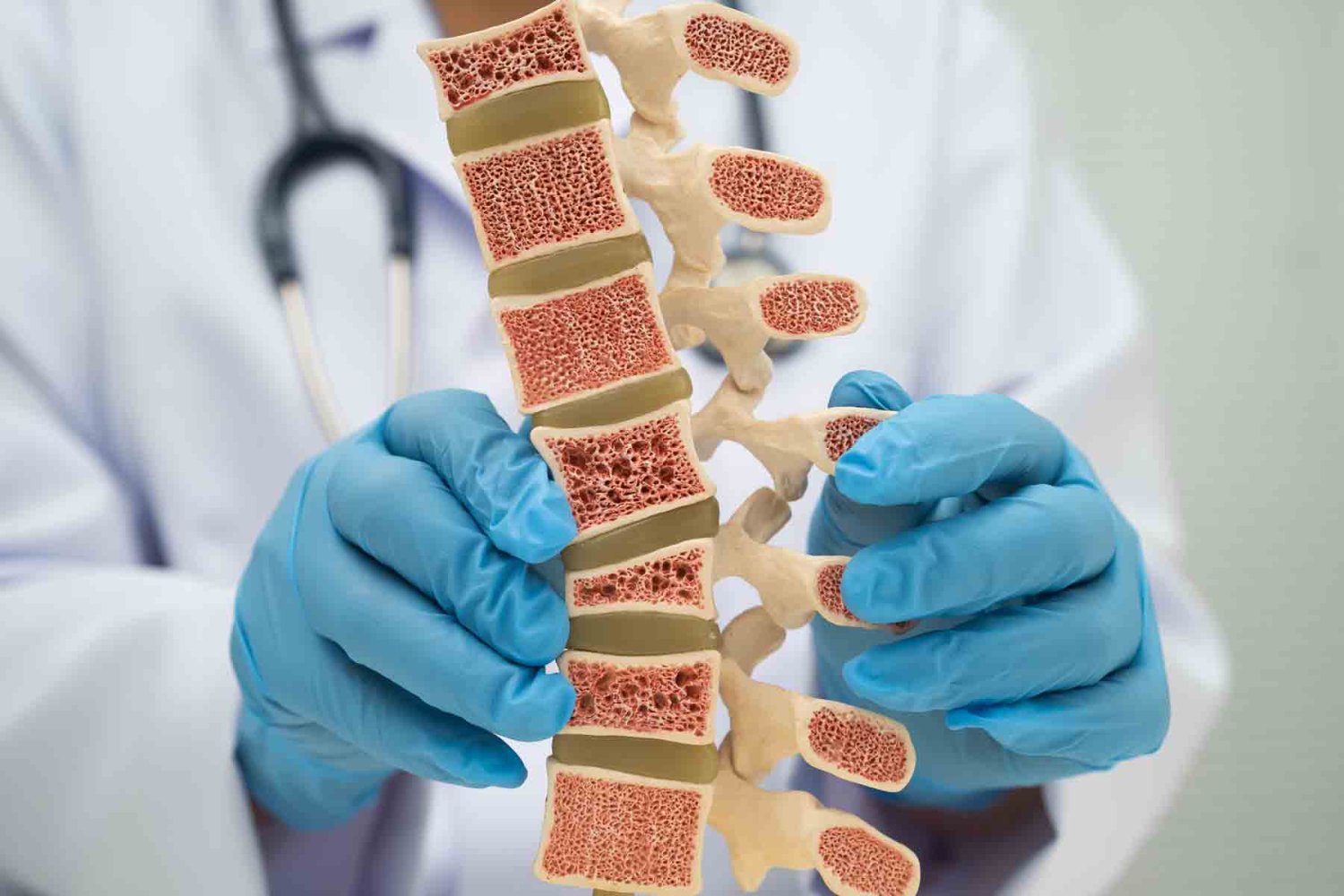 que es la osteporosis